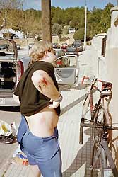 Prellungen und Absch&uuml;rfungen: Bleibende Erinnerungen